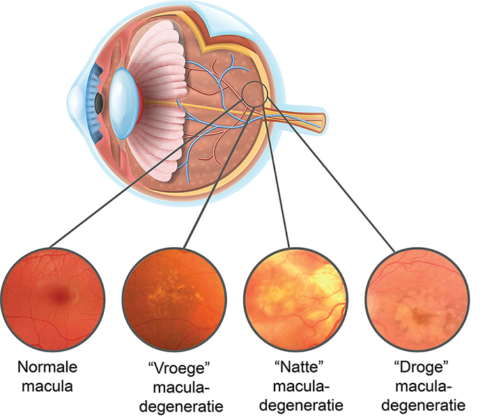 Macular Degeneration Symptoms Causes And Treatment College Review Journal